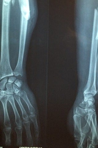 Informe Explica la Creciente Incidencia de Osteomielitis en Alemania